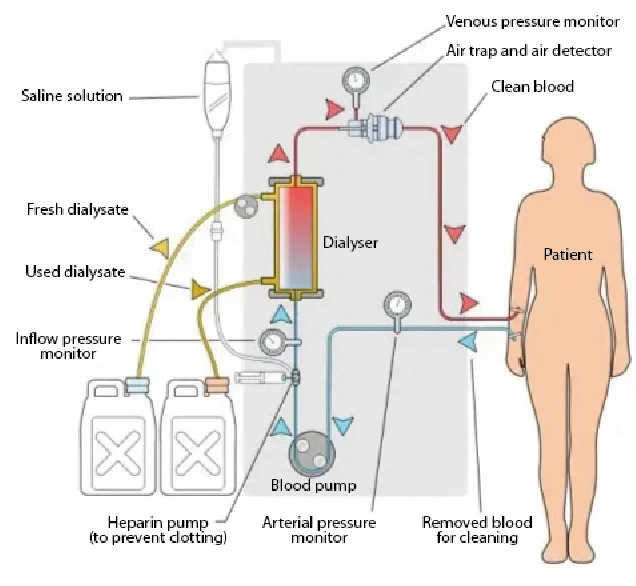 Hemodialysis circuit application diagram