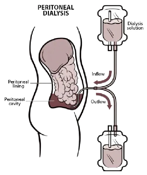 Peritoneal dialysis application diagram